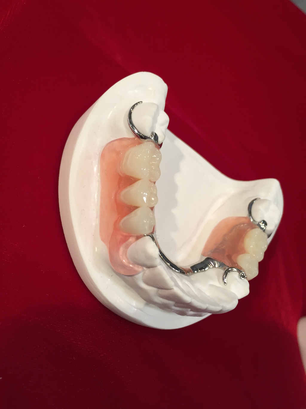 partial denture