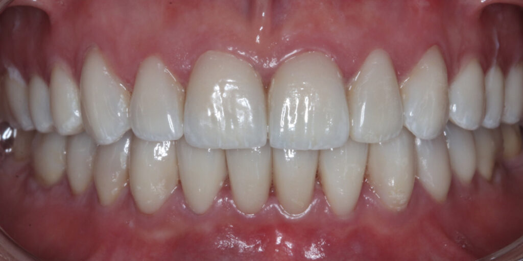 Porcelain Veneers - After