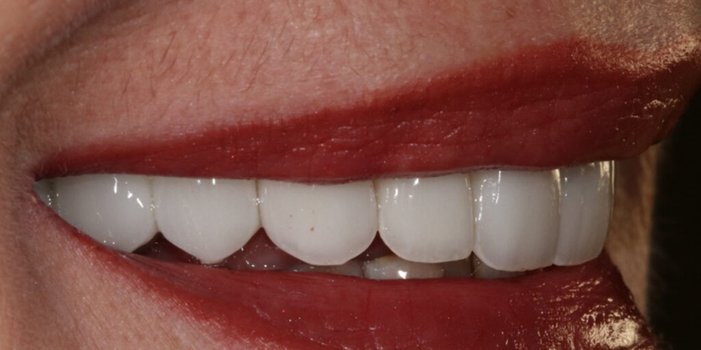 Porcelain Crowns - After