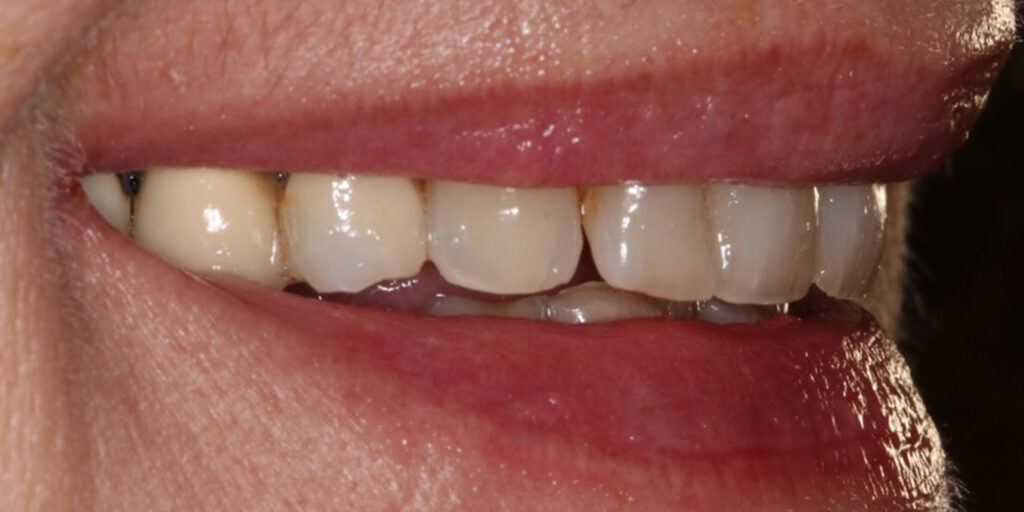 Porcelain Crowns - Before