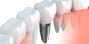 Dental Implants