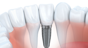 Dental Implant