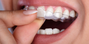 SureSmile Aligners