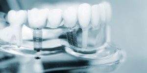 Computer Guided Dental Implants