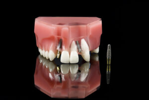 Dental Implant