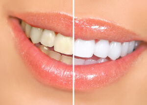 Teeth Whitening Before and After