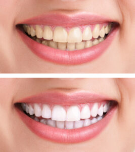 Fixing Troubled Teeth With Porcelain Veneers