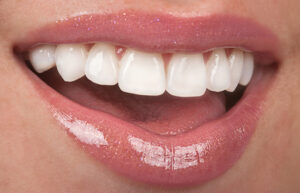 Four Health Reasons To Consider Getting Porcelain Veneers