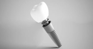 dental implant