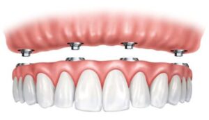 Implants stabilizing dentures