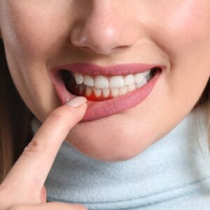 Woman pointing to her red gums