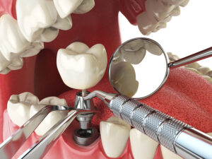 The Dental Implant Process