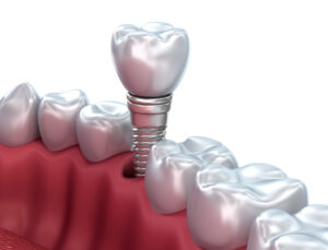 The Ins And Outs Of Implant Porcelain Bridges