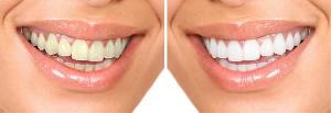 whitening before and after