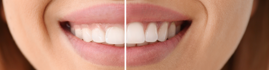 Gum Contouring before and after