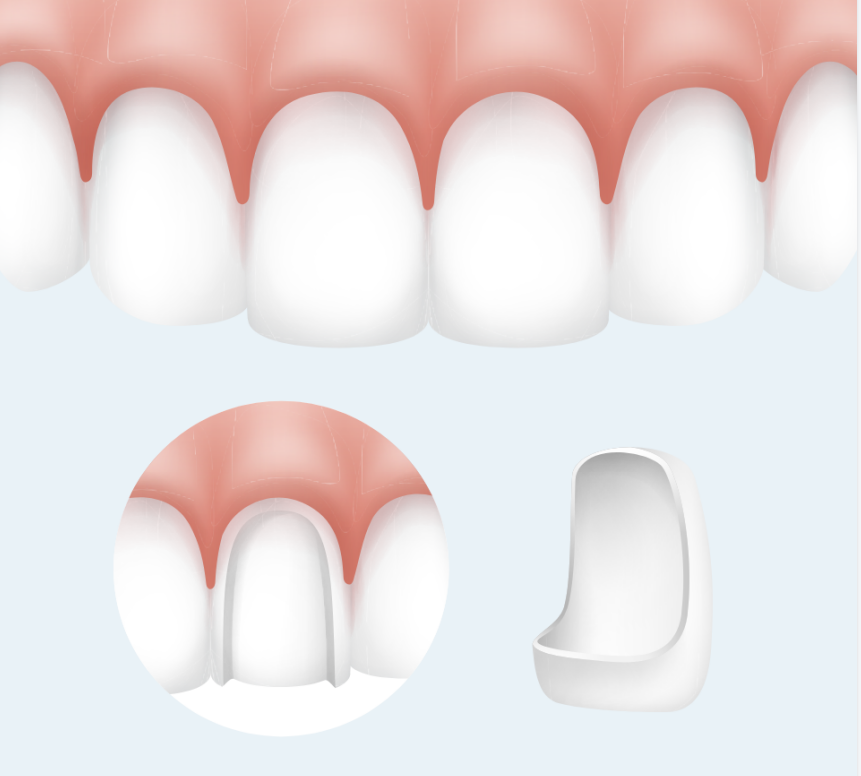 Dental Veneers at Island Dental Associates