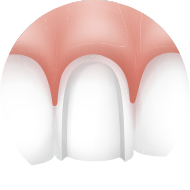 Dental Veneers near me at Island Dental Associates