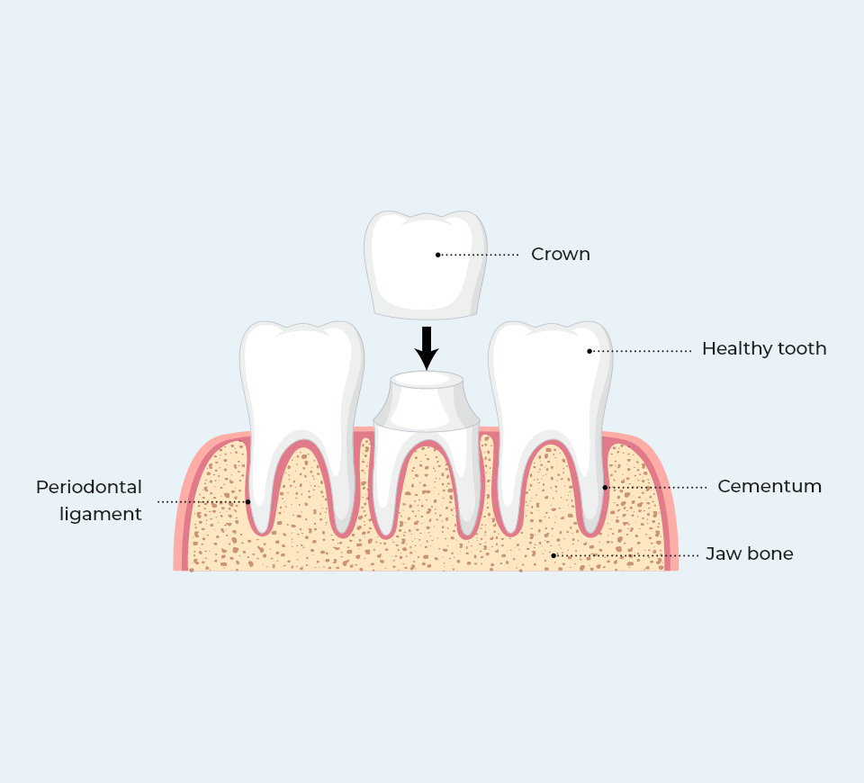 Dental Crowns example model