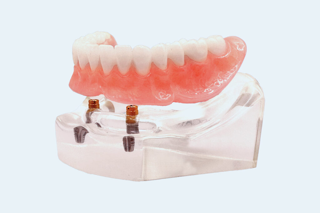 Affordable implant dentures