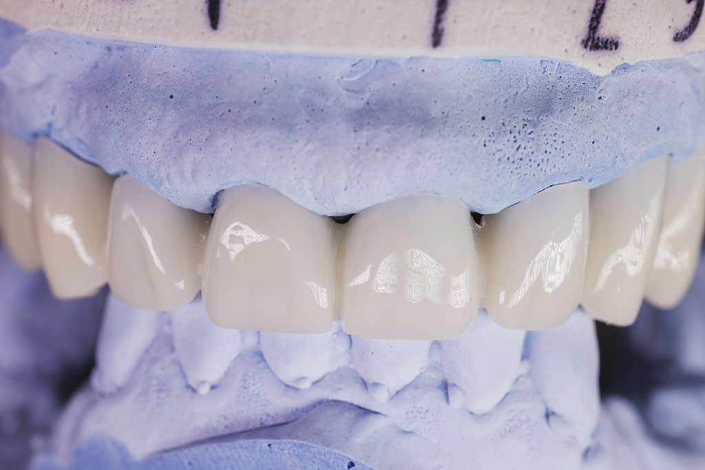 porcelain teeth at Island Dental Associates