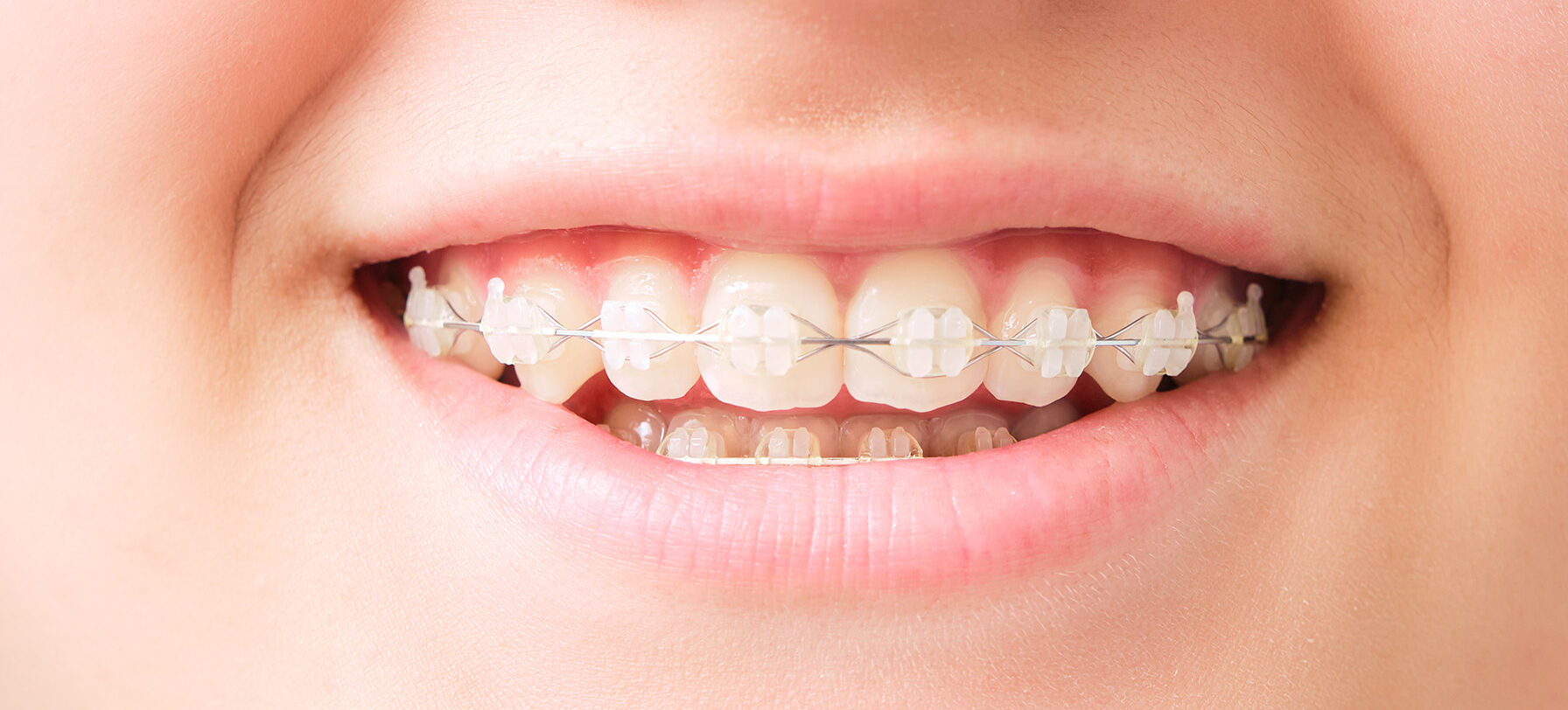 clear braces at Island Dental Associates