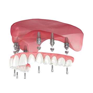 Hybrid-Screw-retained dental implants