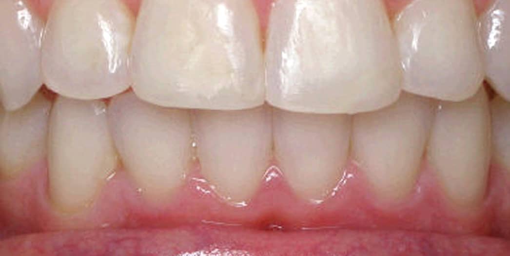 adult male after invisalign