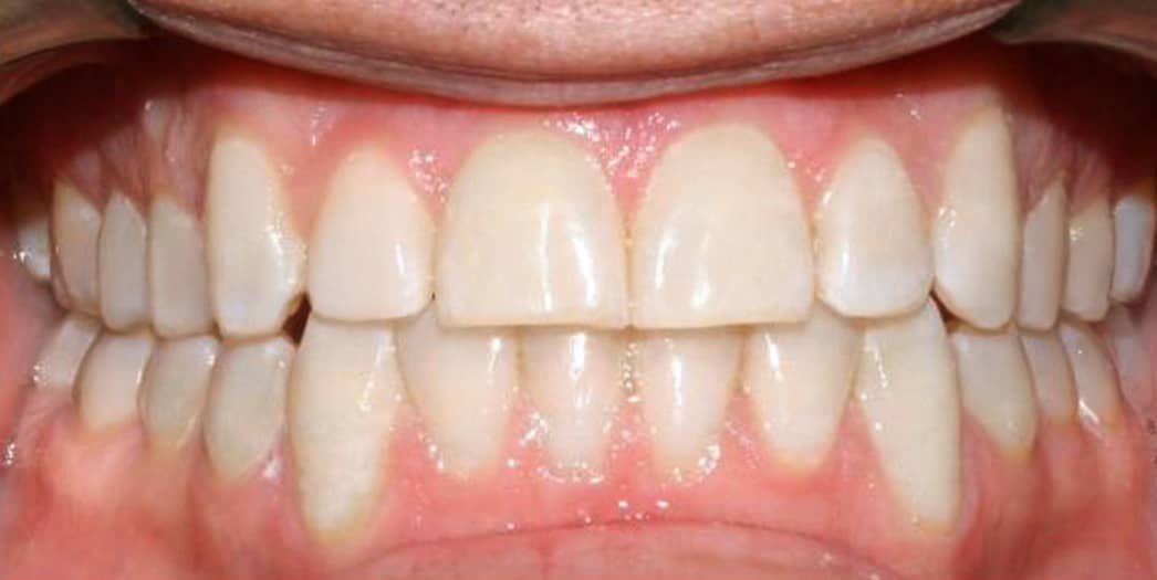 adult male after invisalign