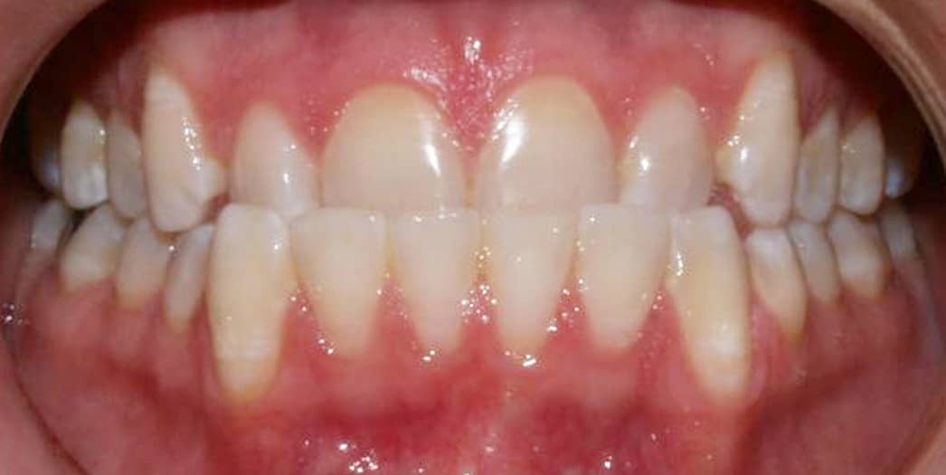 adult male before invisalign