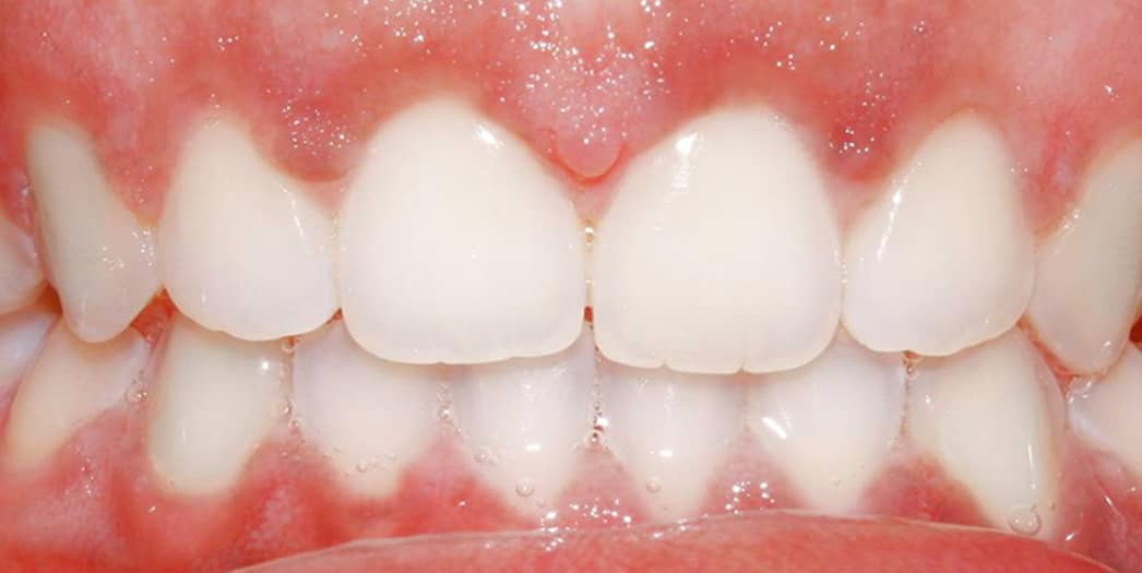 adult woman after invisalign