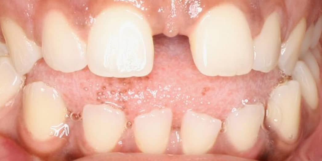 adult woman before invisalign