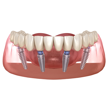 Implants all-on-x