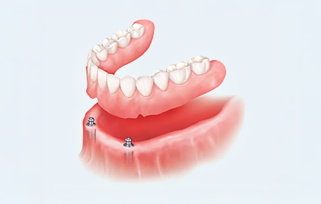 implant dentures at Island Dental Associates