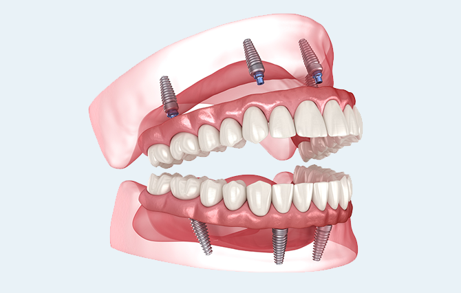 Types Of Dentures - Implant Dentures