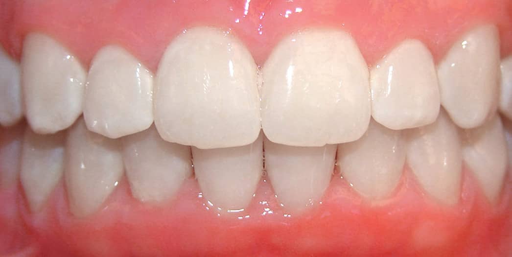 teen girl after invisalign